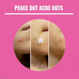 Unicorn Wishes Holographic Iridescent Star Hydrocolloid Acne Pimple Stickers Spotstix 56PK
